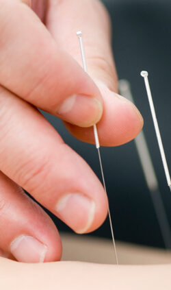 Dr. He - Acupuncture Treatment
