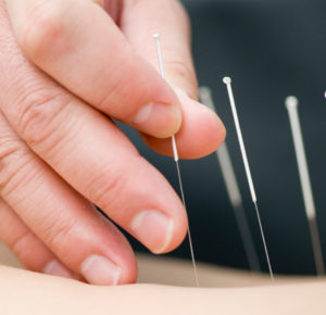 Cancer Acupuncture Holistic Care Dr. He -Acupuncture treatment